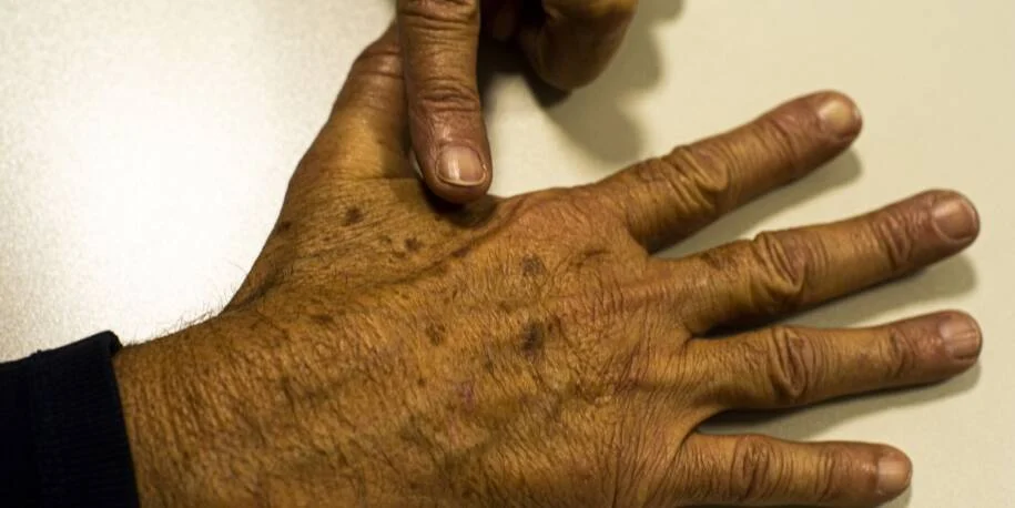 Fundação do Câncer alerta: 5.588 mortes em 2023 e falta de dados críticos