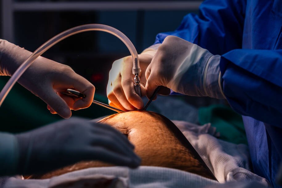 Secretaria de Saúde aprova ampliação de cirurgias bariátricas no Hospital Bethesda