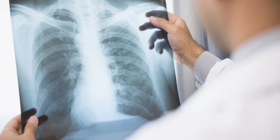 Anvisa aprova Emrelis para câncer de pulmão e traz esperança a pacientes críticos