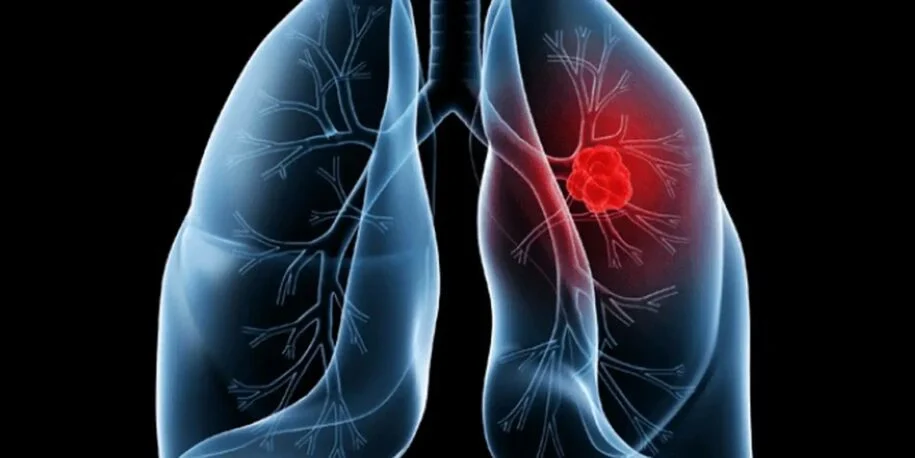 Papa Leão XIV enfrenta adenocarcinoma pulmonar após cirurgia bem-sucedida